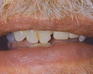 Warren Dental Dental Implants Before