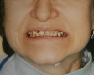 Warren Dental Full Reconstruction Before