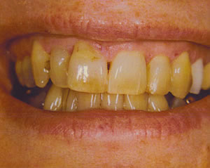 Warren Dental Teeth Whitening Before