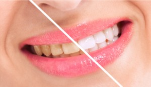 Warren Dentist - Teeth Whitening