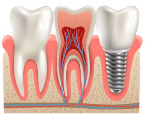 Dental Implant for Missing Teeth - Warren, MI