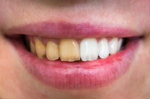 Considering Teeth Whitening for Upcoming Summer Events?