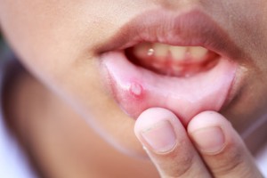 Canker Sores: A Prevalent Oral Condition
