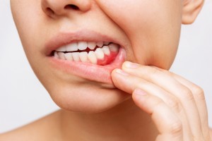 Everything about Gum Infection – Causes, Symptoms, and Treatment