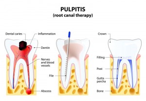 Root Canal Therapy - Warren, MI